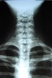 X-ray image of a chest and esophagus | Better Care