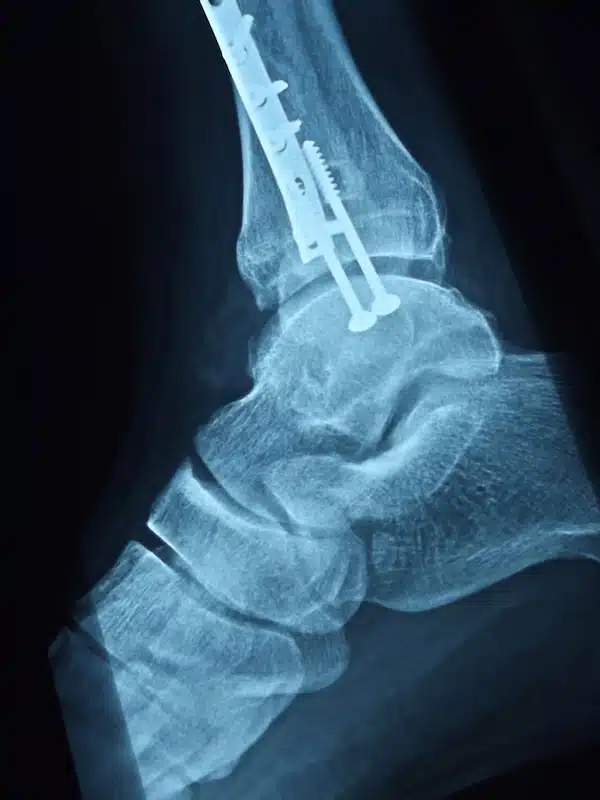 workers compensation medixray of a fractured anklecal insurance