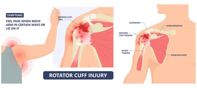rotator cuff injury